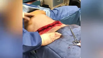 A tummy tuck patient with liposuction to the submental area. #7