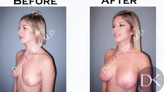 Breast Augmentation and Rhinoplasty #9