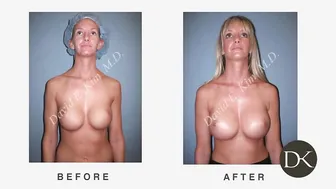 Breast Augmentation: Revision of Breast Implants #10