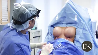 Breast Augmentation with Gummy Silicone Implants #6