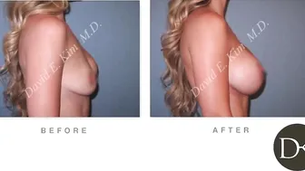 Breast Augmentation - replacing leaked saline implant #10