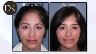 Revision Rhinoplasty