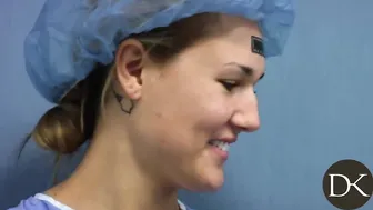 Return Breast Augmentation Patient gets Rhinoplasty #3