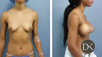 Breast Augmentation: Trans-umbilical Approach #10