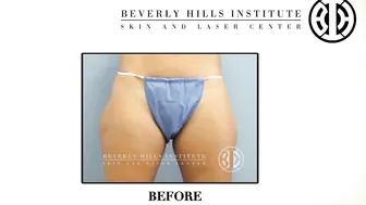 CoolSculpting for outer thigh fat with updated before and after pics #7