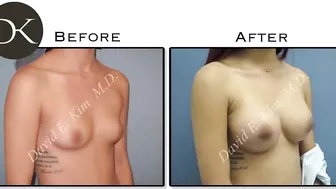 Breast Augmentation Reality Style #10