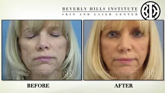 Sculptra for facial volume loss