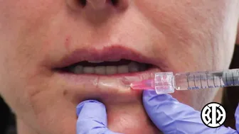 Restylane filler for lip augmentation #7