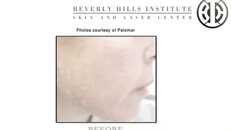 Photofacial laser to treat sunspots #9