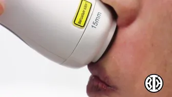 Fractional laser to help reduce melasma #8