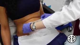 CoolSculpting for the Lower Abdomen