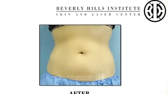 CoolSculpting for the Lower Abdomen #10