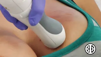 Laser Resurfacing for Stretch Marks on the Breast #4