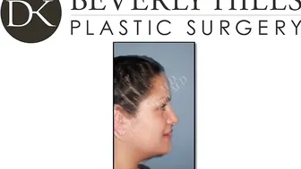 Liposuction Beverly Hills / Los angeles #10