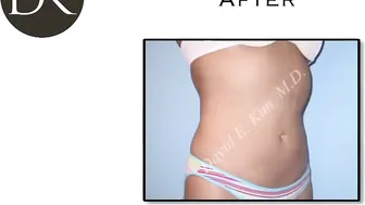 Liposuction Beverly Hills / Los angeles #4