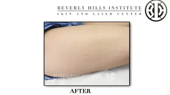 Laser Leg Vein Treatments #9