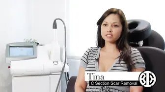 Laser Resurfacing to Treat Surgery Scars #2