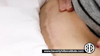 Laser Resurfacing to Treat Surgery Scars #3