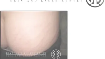 Laser Resurfacing to Treat Stretch Marks #10