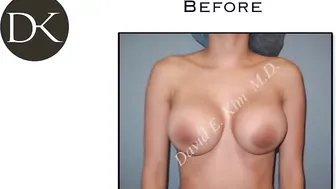 Large Breast Augmentation #10