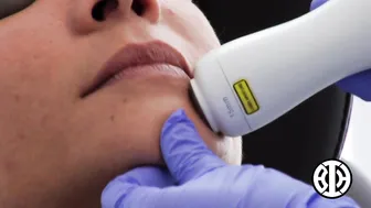 Nonablative fractional resurfacing laser treatments to acne scars #6