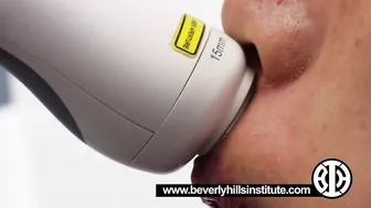 Fractional resurfacing laser for treating Melasma #8