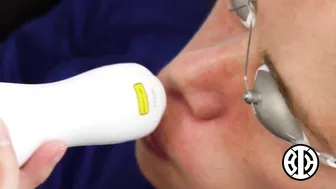 Fractional resurfacing laser for treating Melasma #9