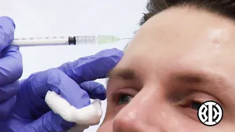 Botox to treat crows' feet and frown lines #4