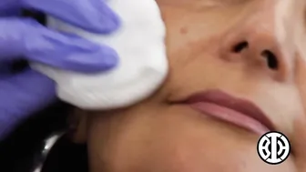 Sculptra to combat collagen deflation in the cheeks #4