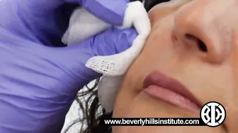 Sculptra to combat collagen deflation in the cheeks #5