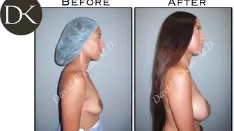 Dual Plane Breast Augmentation: Boob Job #10