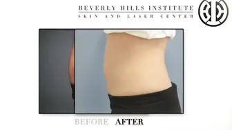 CoolSculpting to Lower Abdomen #10