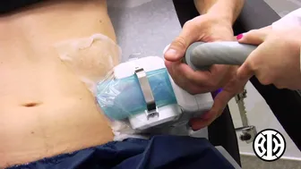 CoolSculpting to treat men's love handles