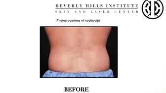 CoolSculpting to treat men's love handles #9