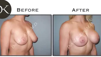 Fitness Model has Breast Augmentation #10