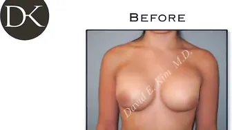 Repairing a bad Breast Augmentation \ Breast Implant Revision #10