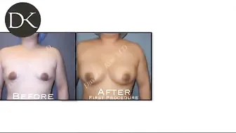 Breast Augmentation Remove and Replace with liposuction #10