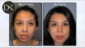 Primary Rhinoplasty with Great Results