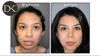 Primary Rhinoplasty with Great Results #10