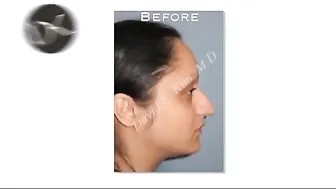 Primary Rhinoplasty Surgery Before and After #10