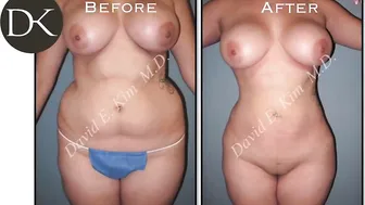 Brazilian Butt Lift and Liposuction #10