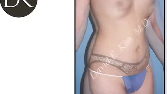 Liposuction Fat Transfer to buttocks: Breast Augmentation #10