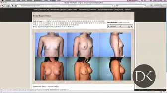 Breast Augmentation Testimonial #4