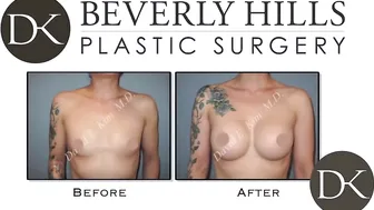 Breast Augmentation Testimonial #6