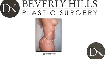 African American Breast Reconstruction #9