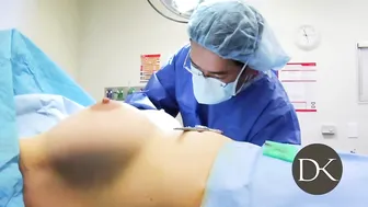 Breast Augmentation: liposuction: and scar correction #7