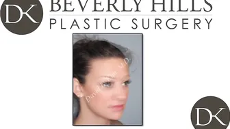 Rhinoplasty Success True Story #10