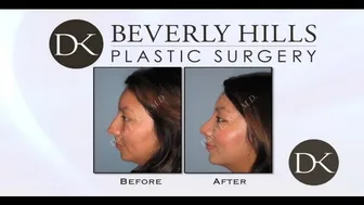 Rhinoplasty recovery in 45 days #1