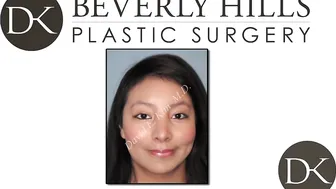 Rhinoplasty recovery in 45 days #10