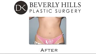 Boob job and Tummy Tuck procedures #10